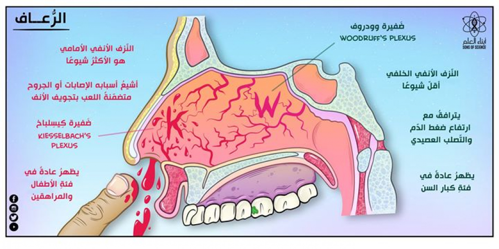 ما هي أسباب نزيف الأنف بالعربيك