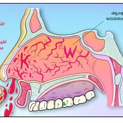ما هي أسباب نزيف الأنف؟