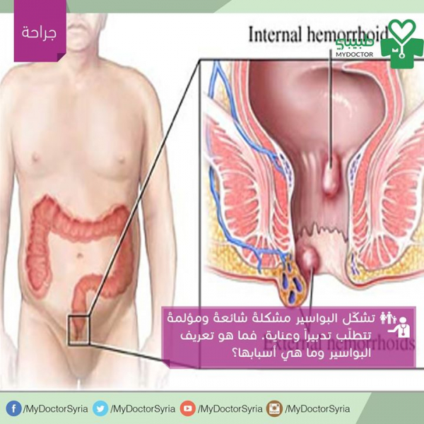 ماهي أسباب البواسير؟