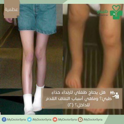 ماهي أسباب التفاف القدم للداخل؟