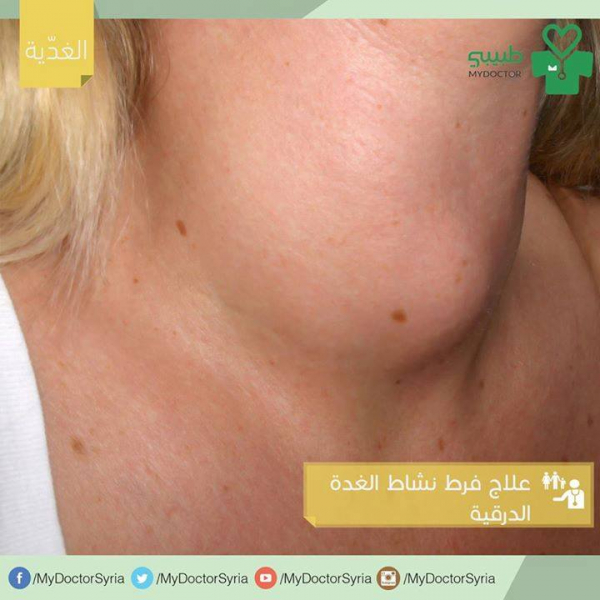 ما هو علاج فرط نشاط الغدة الدرقية بالعربيك