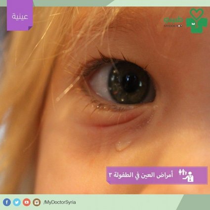 أمراض العين التي تصيب الأطفال، ما هي كيفية التصرف حيالها؟