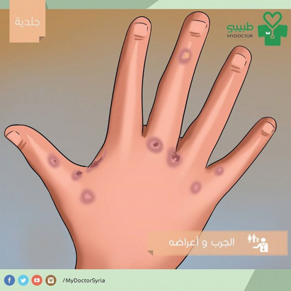 ماهي اعراض الجرب؟