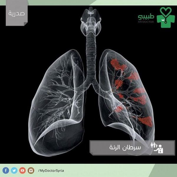 ماهي أعراض سرطان الرئة؟