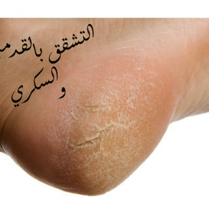 التشقق بالقدمين والسكري