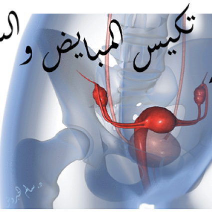 تكيس المبايض والسكري