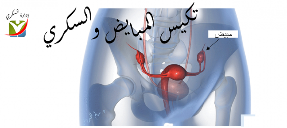 تكيس المبايض والسكري