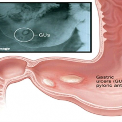 ما هي جرثومة المعدة التي تصيب معظم سكان الكرة الأرضية ؟