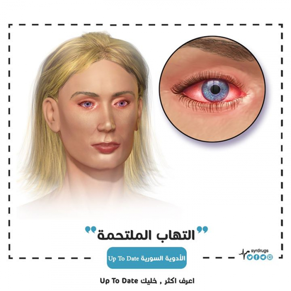 ما هي أسباب التهاب الملتحمة؟