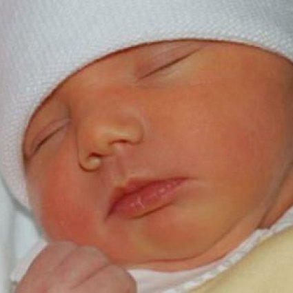 اليرقان الوليدي