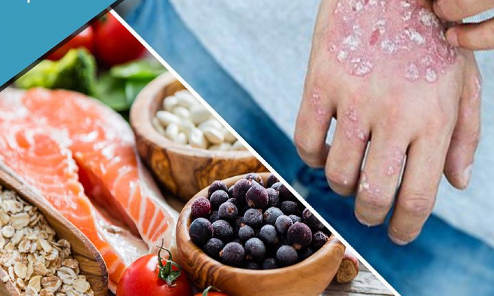 الحمية الغذائية يمكن أن تقلل من شدة الصدفية