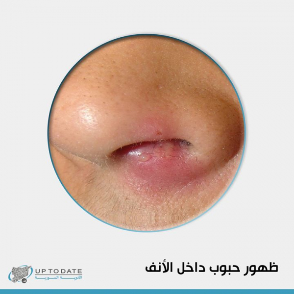 ما هي أسباب ظهور حبوب داخل الأنف؟