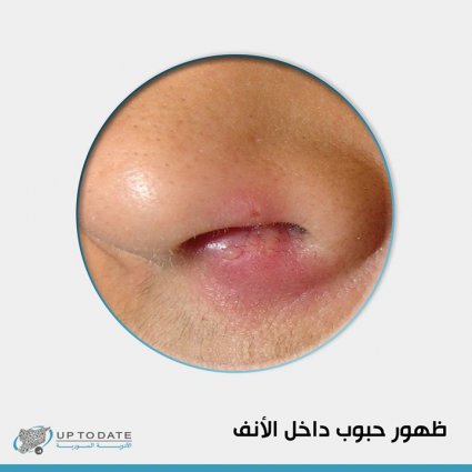 ما هي أسباب ظهور حبوب داخل الأنف؟