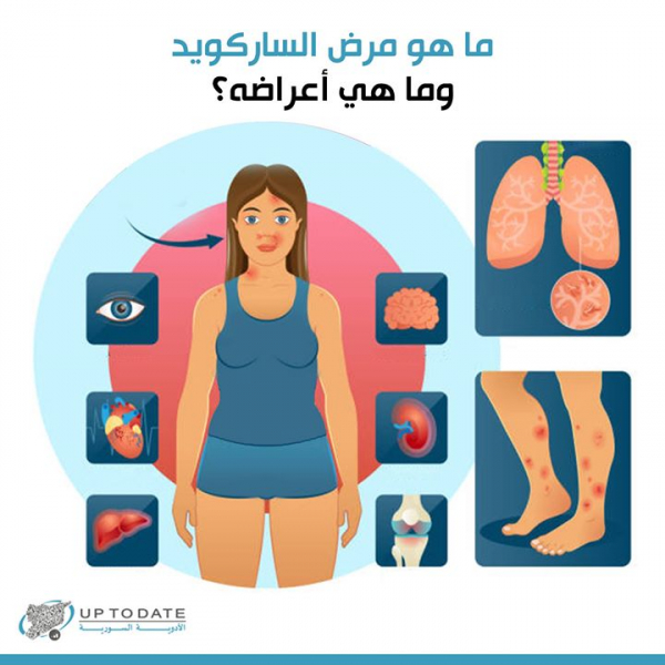 ما هو مرض الساركويد؟