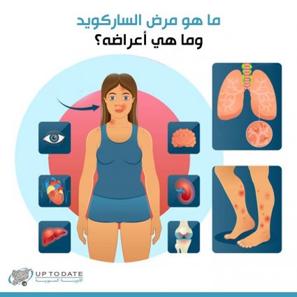 ما هو مرض الساركويد؟