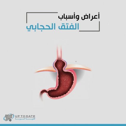 ما هو الفتق الحجابي؟
