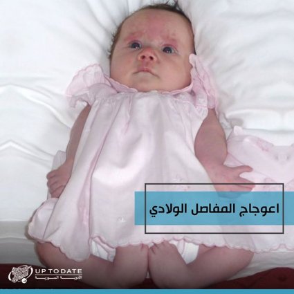 اعوجاج المفاصل الخلقي عند الأطفال