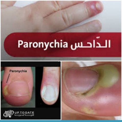 داحس الأصابع