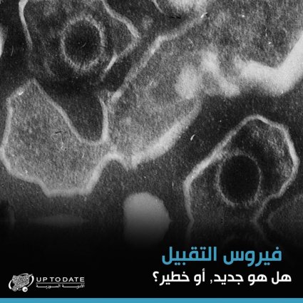 فيروس التقبيل