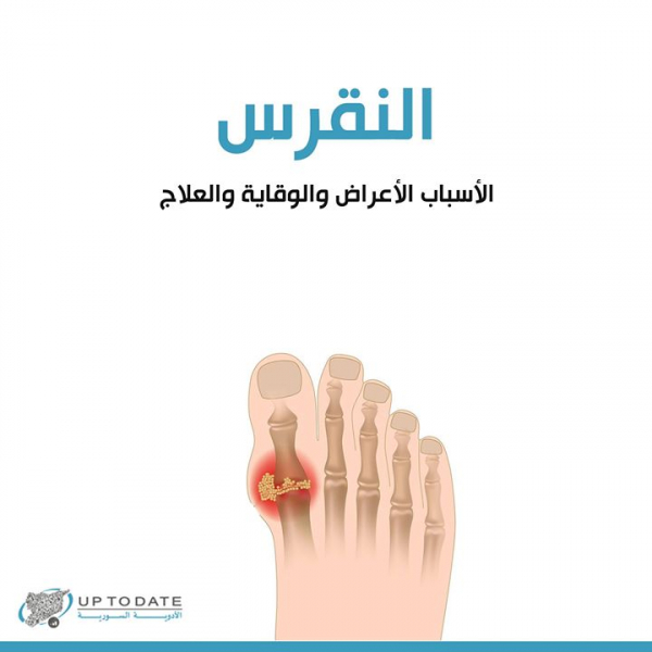 ما هو مرض النقرس؟