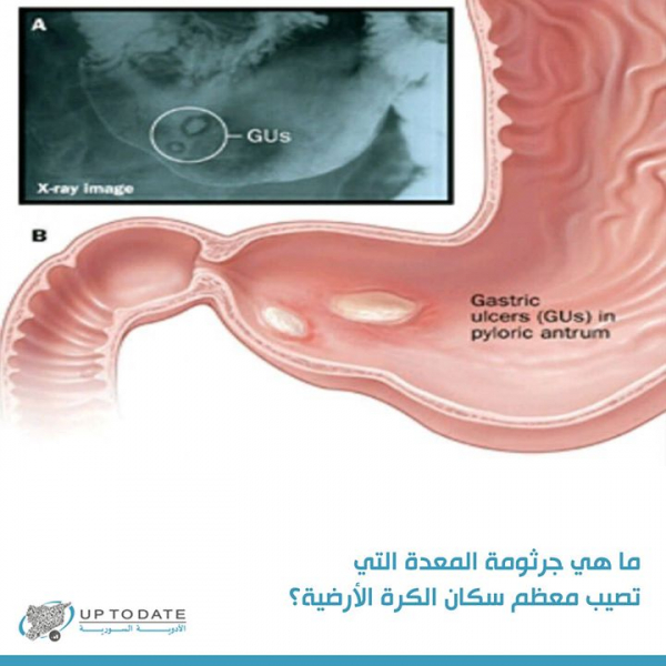 ماهي جرثومة المعدة التي تصيب معظم سكان الكرة الأرضية ؟