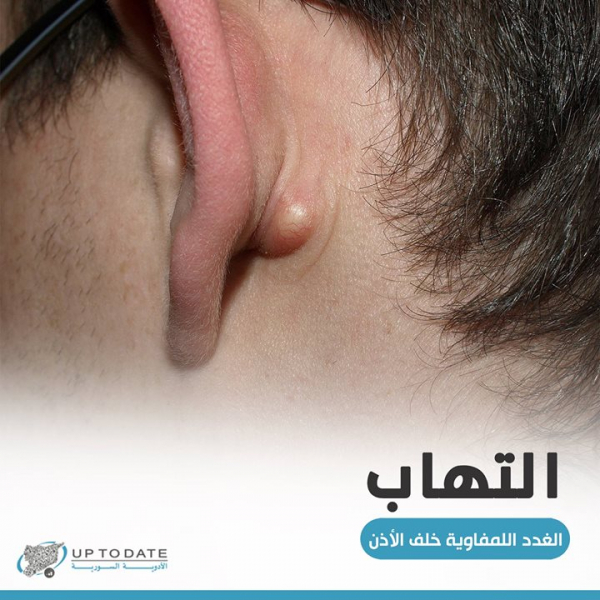 ما هي أسباب التهاب الغدد اللمفاوية؟
