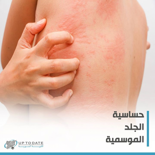 حساسية الجلد الموسمية