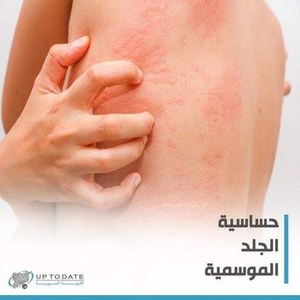 حساسية الجلد الموسمية