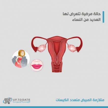 متلازمة المبيض متعدد الكيسات