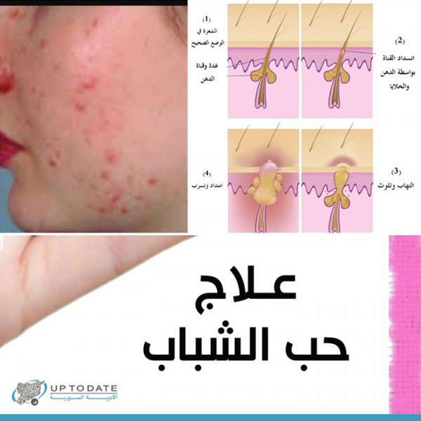 ما هي أسباب حب الشباب بالعربيك