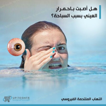 هل ذهبت إلى مسبح عام وأصبت باحمرار في العينين؟