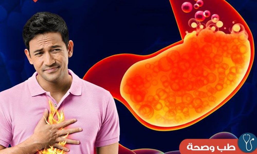 ما هي حرقة المعدة؟