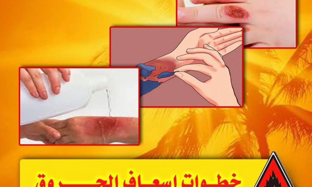 ما هي خطوات إسعافات الحروق؟