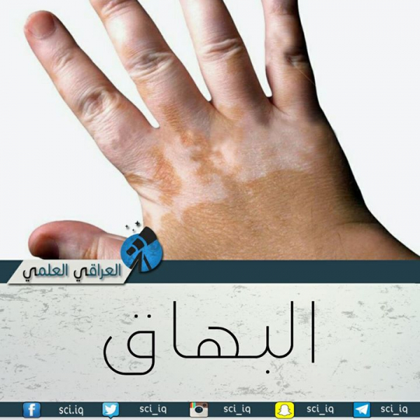 مرض البهاق