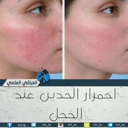 ما هو سبب احمرار الخدين عند الخجل؟