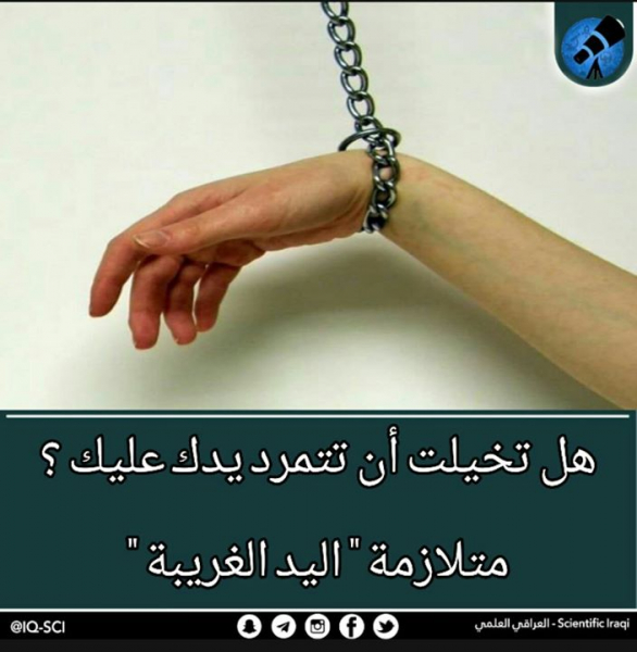 مُتلازمة اليد الغريبة!